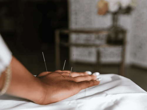 Akupunktura dystalna